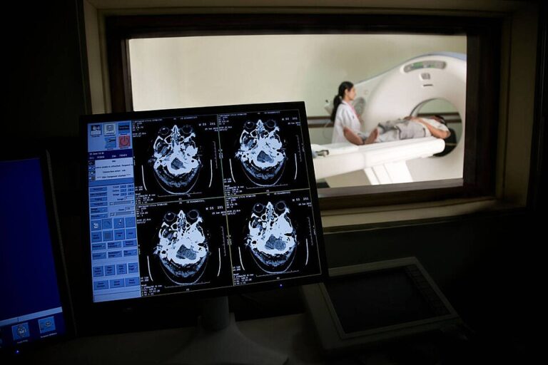 Study Links Persistent Fatigue in Long COVID to Reduced Cerebral Blood Flow